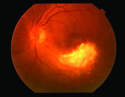 cmv retinitis left eye